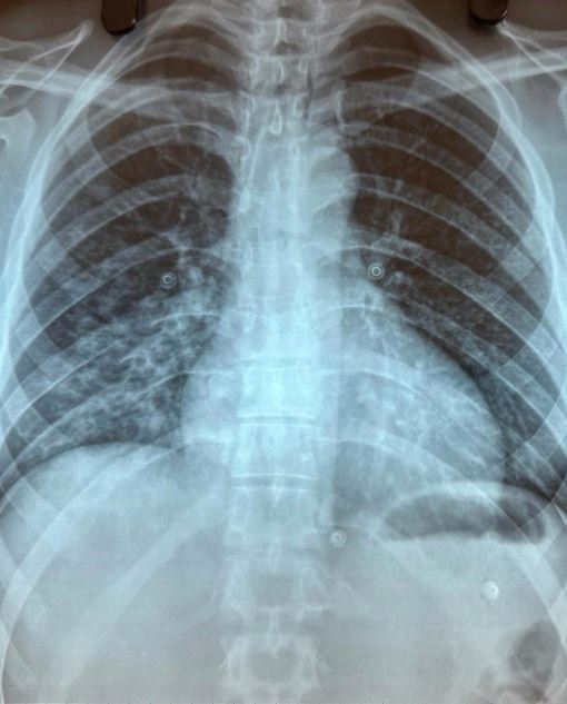 X-ray of Aymar Navarro's lung